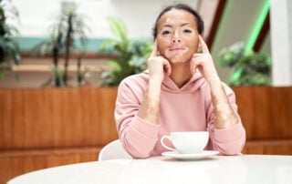 viralmd-marketing-healthcare-3-Early-Signs-Of-Vitiligo-When-At-Home-Remedies-Arent-Enough